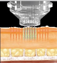 Medical Microneedling 1 microneedling elektroporation