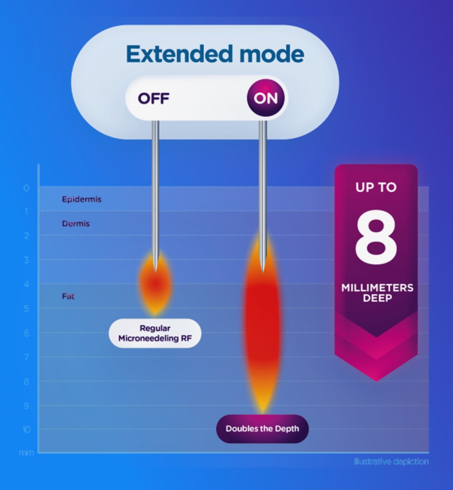 EXION RF Microneedling Rostock